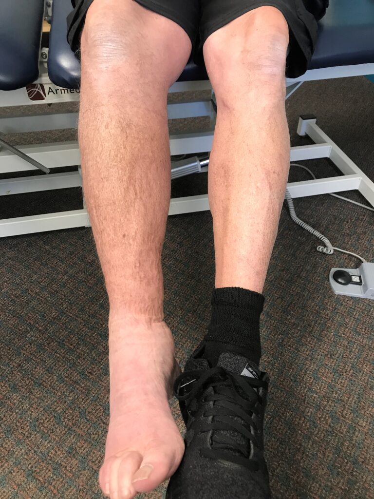 After treatment of the Right Lower Extremity