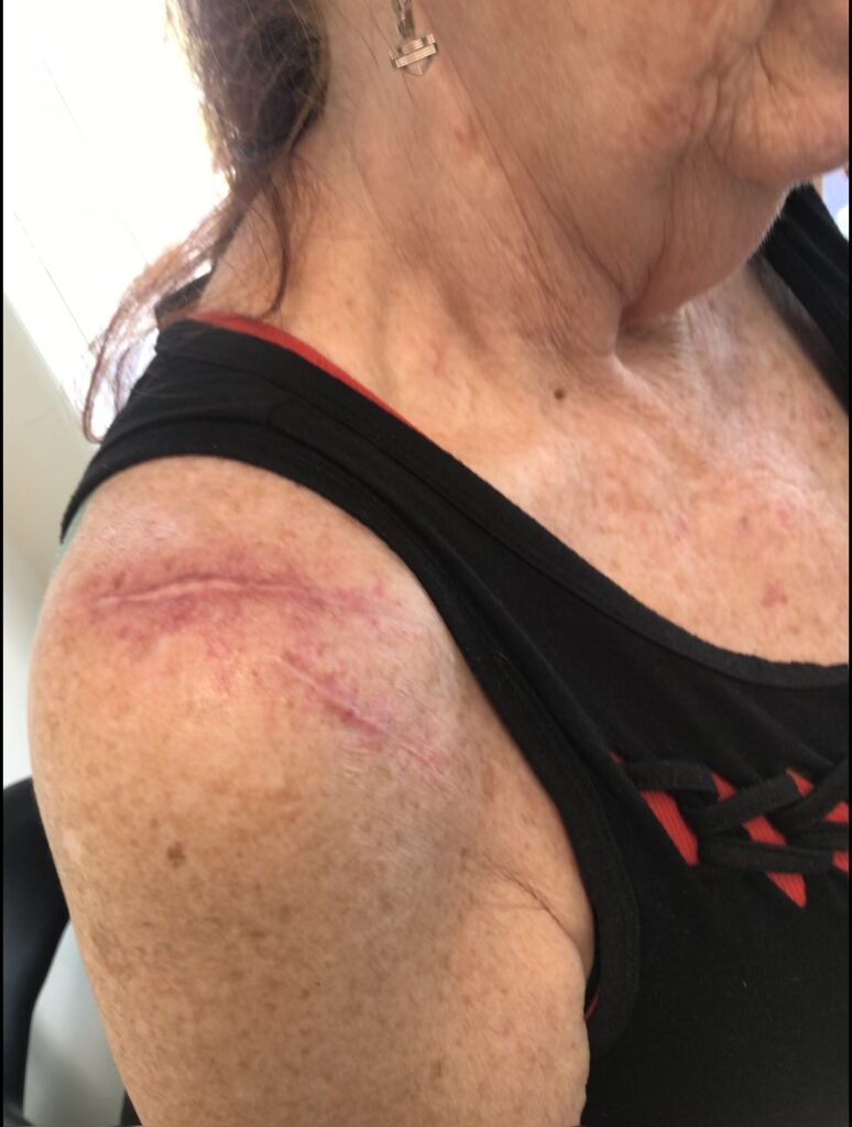 SHOULDER SURGERY SCAR TREATMENT AFTER 2 TREATMENTS