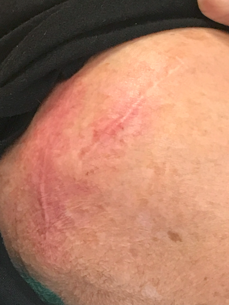 SHOULDER SURGERY SCAR RESULTS AFTER 4 TREATMENTS