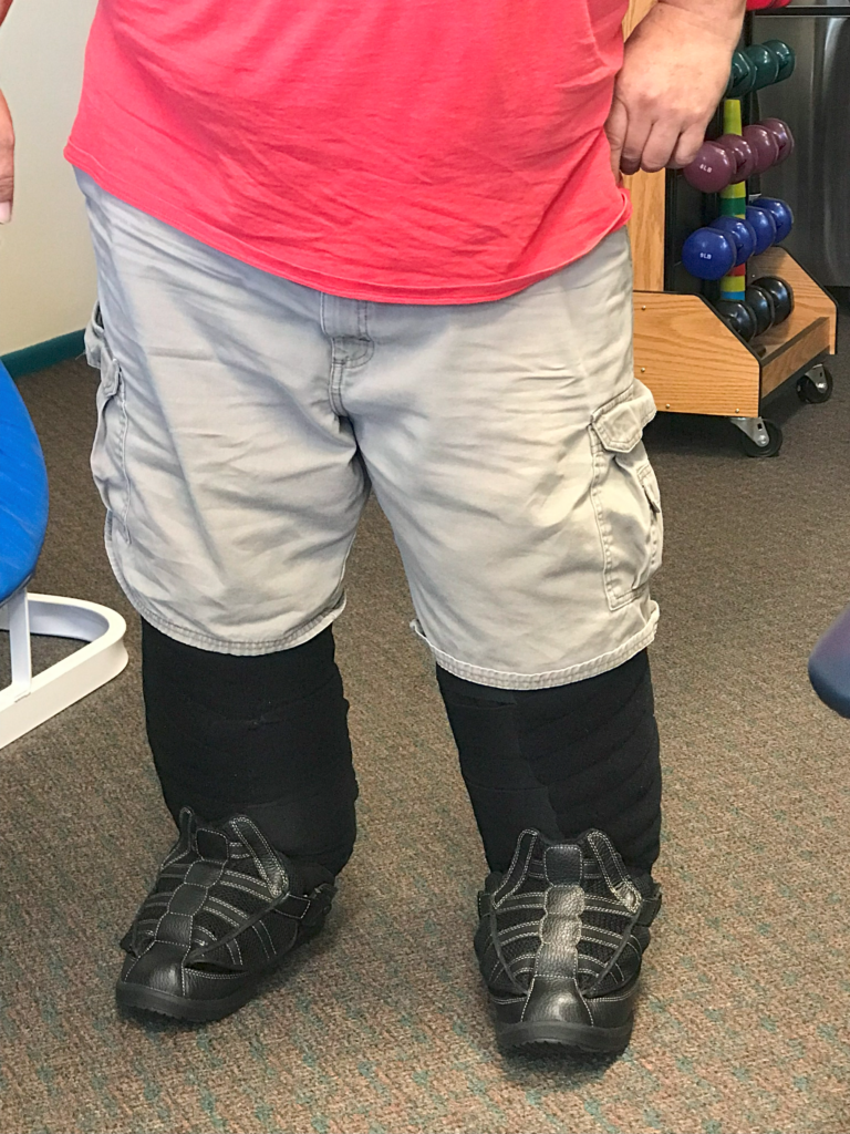 STAGE 4 LYMPHEDEMA IN THE BILATERAL LOWER EXTREMITIES FOLLOWUP WITH PATIENT WEARING HIS DAILY GARMENTS AND IMPROVED MOBILITY (TREATMENT LASTED 4 MONTHS)