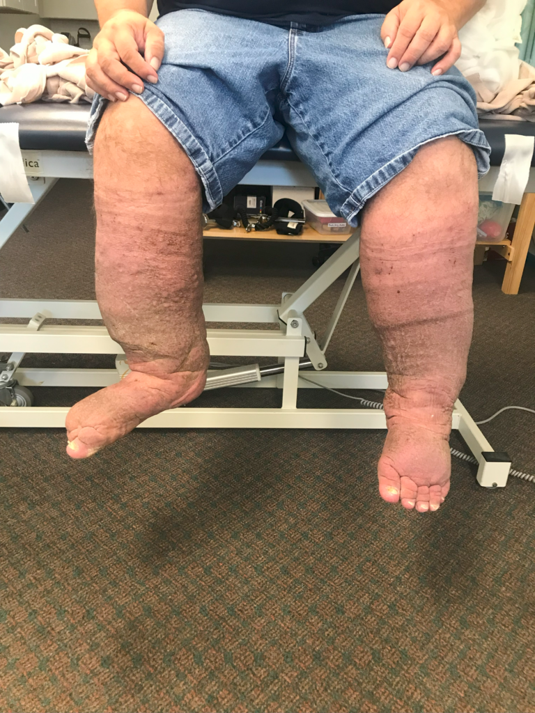 STAGE 4 LYMPHEDEMA IN THE BILATERAL LOWER EXTREMITIES WITH LYMPHATIC CYSTS  DISAPPEARING AND NOTICEABLE SIZE DECREASE DURING TREATMENT 