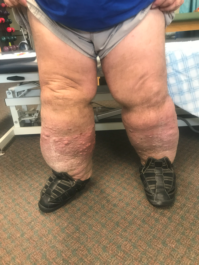 STAGE 4 LYMPHEDEMA IN THE BILATERAL LOWER EXTREMITIES WITH LYMPHATIC CYSTS PRIOR TO TREATMENT 